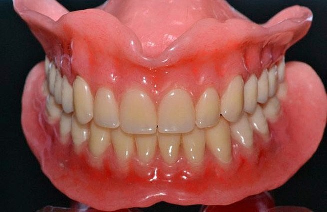 Воспаление десен под зубным протезом
